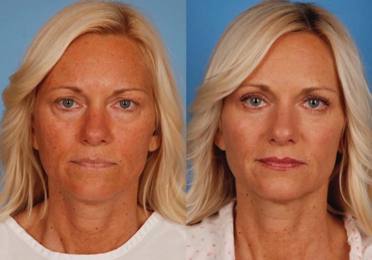 New York City Upper Eyelid Surgery Quotes 