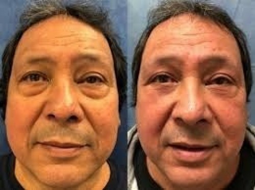 New York City Lower Eyelid Surgery Cost